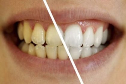 Cara Memutihkan Gigi Kuning Secara Alami