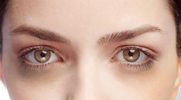 Cara Menghilangkan Kantung Mata dan Lingkaran Hitam